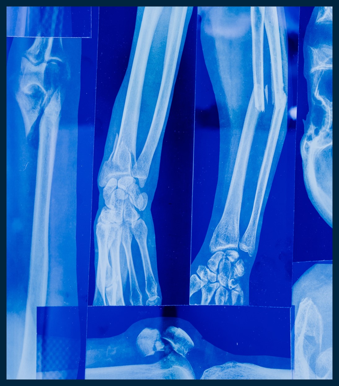 An x-ray images of arms and fractured bones.
